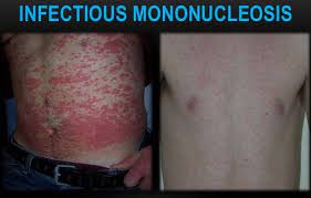 Typical features of infectious mononucleosis include fever. Infectious Mononucleosis Ask Hematologist Understand Hematology