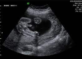 My Baby Youll Be 3d Early Gender Reveal Hd Ultrasound