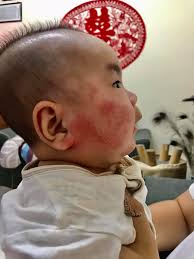 What can I do to help with my son's itchy rash?