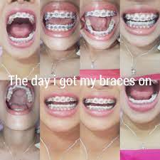 Hayyyaaaah It Hurts Like Fack I Kennot Huhuhuh Braces Tips Dental Braces Brace Face