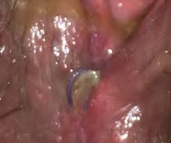 The symptoms of a perineal tear are: Infected Perineal Stitches Babycenter