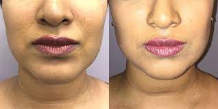 + buccal fat removal surgery with harley street skin begins at £3500. Buccal Fat Removal Cheek Contouring From 111 Harley St