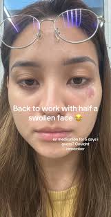 Half My Face Is Swollen