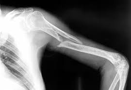 Hizmetler Humerus Kirigi