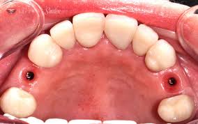 Check spelling or type a new query. Single Tooth Dental Implants Single Dental Implant Cost Near Me