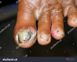 Image result for Paronychia feet