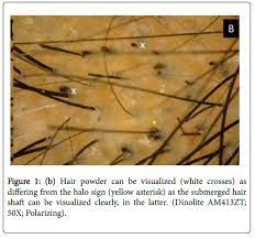  dots  correspond to hair follicle openings observed in trichoscopic examination. Two New Signs Halo Sign And Wipeout Sign To Differentiate Black Dots From Hair Dust On Trichoscopy