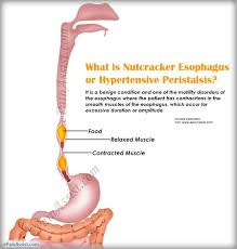 What Is Nutcracker Esophagus Or Hypertensive Peristalsis Nutcracker Esophagus Esophageal Spasm Weight Help