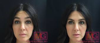 Check spelling or type a new query. Botox Eyebrow Lift Forehead Lines Glabella Area