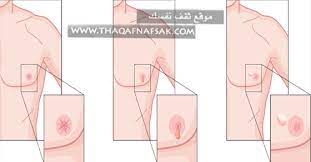 مضحك كمثرى ظاهرة عوارض سرطان الثدي عند النساء dsvdedommel com