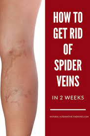 How To Get Rid Of Spider Veins In 2 Weeks Naturally Get Rid Of Spider Veins Spider Veins Veins Treatment