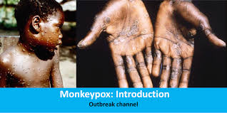 The illness usually begins with a fever, headache, . Monkeypox Introduction Openwho Staging