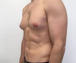 The male breast is structurally and functionally different from female breast due to the hormones that guide its growth and maturity. Male Breast Reduction How Can I Get Rid Of Gynecomastia Fast