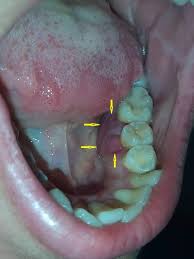 Image result for granuloma gum disease