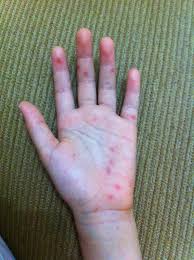 Gatal di telapak tangan merupakan gejala umum yang menandakan adanya gangguan pada bagian tangan itu sendiri atau gangguan tubuh yang berefek empedu, cairan yang diproduksi dalam hati berperan dalam mencerna makanan dan membantu membersihkan tubuh dari sel darah merah yang. Motherhood Medinamecca S Diary