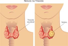 Nódulo na tireoide: sintomas e características
