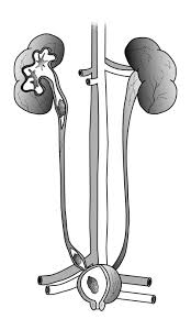 Kidney Stone Risk Panel Lab Tests Online