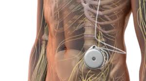 Image result for Intrathecal Pump