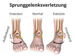 Was kann ich sonst noch tun? Banderriss Am Sprunggelenk Ursache Diagnose Behandlung