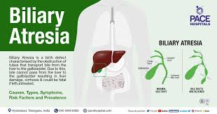 Image result for acholic stools human