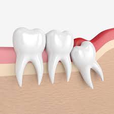 Wisdom teeth are the last molars to erupt in adulthood. Wisdom Teeth