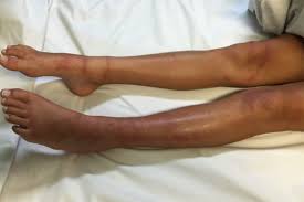 See full list on mayoclinic.org Box Jellyfish Stings To Vinegar Or Not Resus