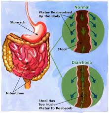 If your diarrhea is caused by a more serious condition, such as inflammatory bowel disease, your. Child With Diarrhoea