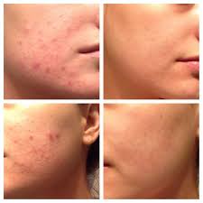 Doxycycline Acne What To Know About Doxycycline