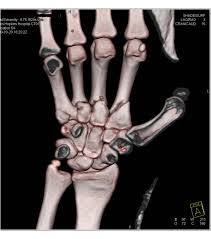 Image result for Hand Fracture