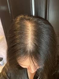 I'm 14 years old and i'm losing my hair. I M 23 And My Hair Has Been Thinning The Past 7 Years Any Advice For Hair Loss And Growing Back My Hair Density Femalehairadvice