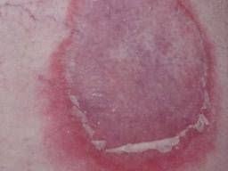 Image result for Pemphigoid