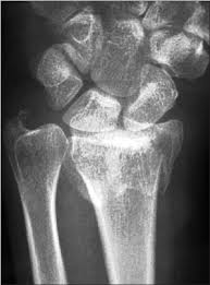 Percutaneous K Wire Fixation Of Distal Radius Fractures Our