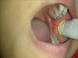 Inferior Alveolar Nerve Block Youtube