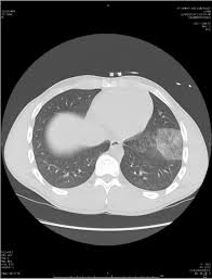 Image result for Pulmonary Contusion