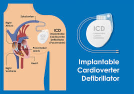 Image result for Internal Cardiac Defibrillator