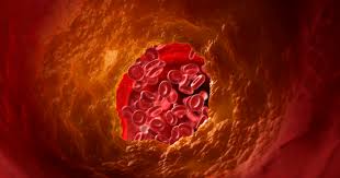 It's mainly caused by eating fatty food, not exercising enough, being overweight, smoking and drinking alcohol. High Cholesterol And Your Risk For Heart Disease Get Healthy Stay Healthy