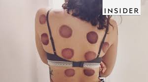 Here are five good spots to go for a session in nyc. Cupping Therapy Youtube