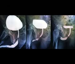 Image result for Voiding Cystourethrogram
