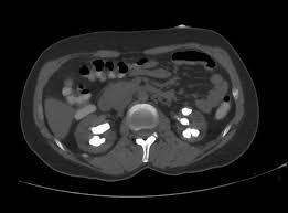 Image result for Nephrolithiasis Imaging