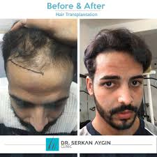 Before After Sacekimi Sacekimiuzmani Sacekimmerkezi Sacekimioncesi Sacekimisonrasi Drserkanaygin Hairtransplant Hair Hair Transplant Hair Transplant