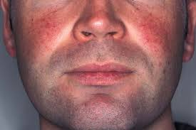 Image result for red rash face
