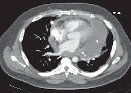 Pdf Case Of Primary Pericardial Mesothelioma Semantic Scholar