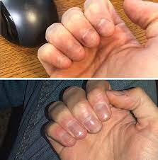 Common signs/symptoms may include the following. 10 Tips To Stop Biting Your Nails Once And For All