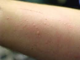 Stress Induced Hives Can Stress Cause Hives Stress Rash Chronic Hives Hives Remedies Hives Causes
