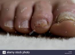 Zehennagel Schaden Schliessen Oben Fusse Eines Alten Mannes Mit Zehennagel Trauma Und Bakterielle Infektion Stockfotografie Alamy