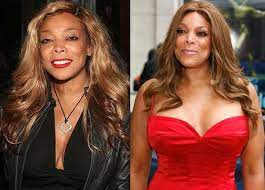 Wendy openly shared she went under facelift, botox injections, Wendy Williams Had Plastic Surgery Photo And Other Evidence Before And After Operations Plasticsurgeryofstars Com