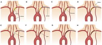 Please expect a delay when contacting customer support at 1.800.457.4500 or customersupport@cookmedical.com. Frontiers Combined Transradial And Transfemoral Approach With Ostial Vertebral Balloon Protection For The Treatment Of Patients With Subclavian Steal Syndrome Neurology