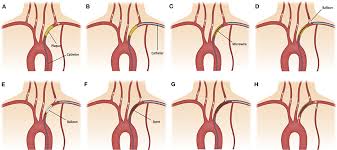 Length (cm), balloon volume ml. Frontiers Combined Transradial And Transfemoral Approach With Ostial Vertebral Balloon Protection For The Treatment Of Patients With Subclavian Steal Syndrome Neurology