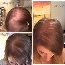 Biotin may help with hair growth if you have a biotin deficiency. Biotin Hair Growth Before And After Pictures