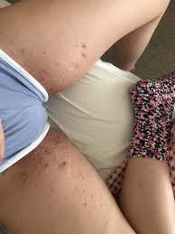 In most situations, ingrown hair disappears naturally on their own because the hair eventually grows out of the skin's surface. Ingrown Hairs On Bikini Line Mumsnet